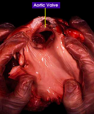 aortic valve