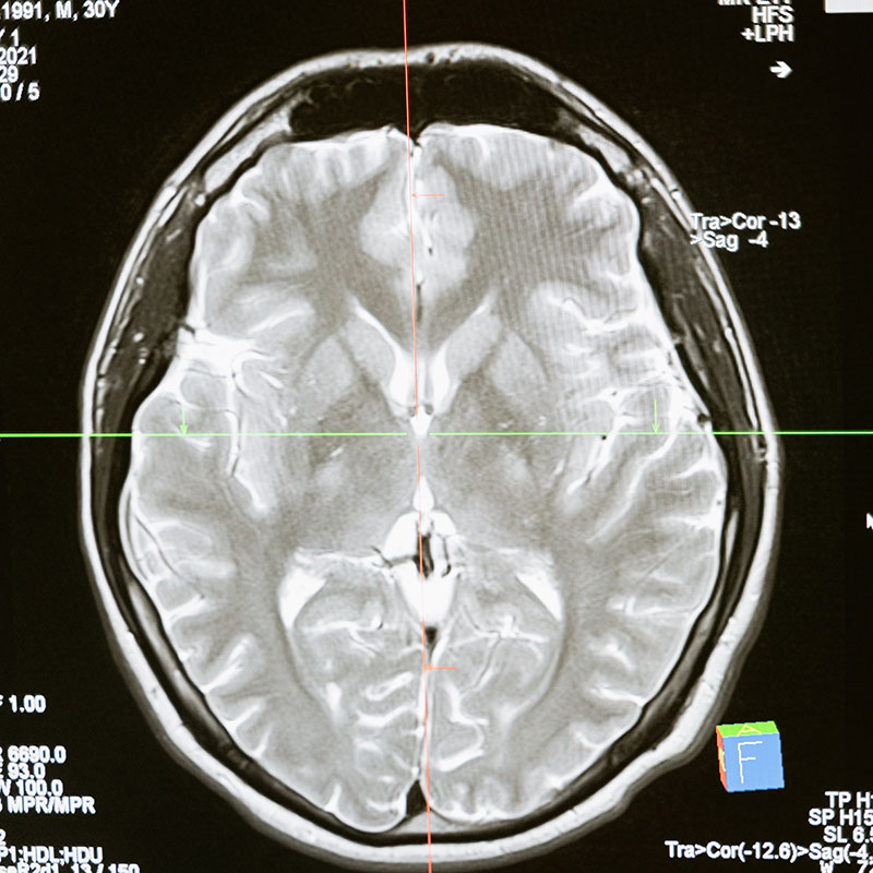 Brain xray.